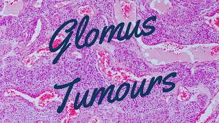 Glomus Tumours  Pathology mini tutorial [upl. by Annoit]