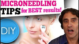 MICRONEEDLING DIY at HOME  What You Need to Know [upl. by Eicarg]