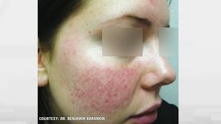 Rosacea relief How to treat persistent facial flushing [upl. by Frankie]