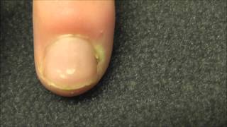 A finger infection near the nail bed or Paronychia as it is called medically [upl. by Divadnahtanoj541]