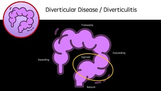 Diverticular Disease and Diverticulitis [upl. by Naivad]