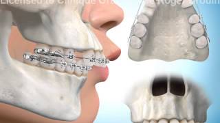 Extractions de dents pour correction surplomb horizontal [upl. by Jeddy]