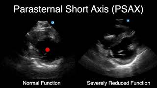 IVC Ultrasound STEP by STEP  Easiest Method [upl. by Bedelia]