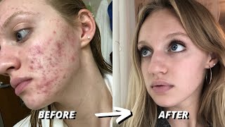 HOW I CLEARED 7 YEARS OF SEVERE ACNE  ACCUTANE JOURNEY [upl. by Ecadnarb]