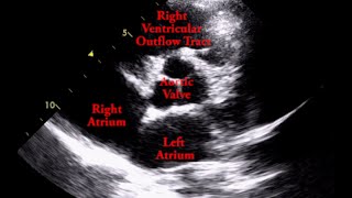 Aortic Valve  Parasternal Short Axis [upl. by Kele]