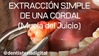 EXTRACCIÓN SIMPLE DE UNA CORDAL Muela del Juicio [upl. by Rivkah]