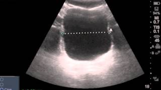 IVC Fully Collapsing with Spontaneous Respiration [upl. by Anayeek]