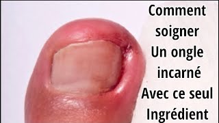 Comment soigner un ongle incarné naturellement [upl. by Annauqal]