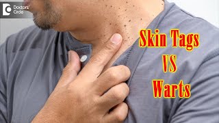 What Causes Skin Tags And Warts  Get Rid of Warts amp Skin Tags Dr Renuka Shetty  Doctors Circle [upl. by Owiat943]