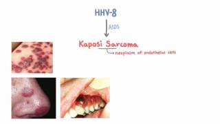 Angiosarcoma 5Minute Pathology Pearls [upl. by Eddina780]