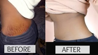 Laser treatments for stretch marks after delivery  Dr K Prem Anand [upl. by Hilel]