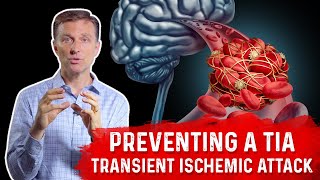 How To Prevent TIA Transient Ischemic Attack MiniStroke – DrBerg [upl. by Eichman]