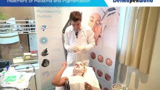 Dermapen 4 Treatment Melasma [upl. by Bernstein]