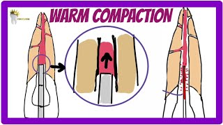 ENDODONTICS  OBTURATION TECHNIQUES  Warm Vertical Compaction technique [upl. by Rdnaskela396]