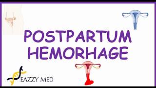 Intracranial Haemorrhage Types signs and symptoms [upl. by Oribelle]