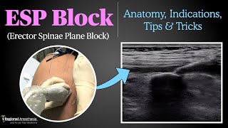 Erector Spinae Plane ESP Block [upl. by Castorina]