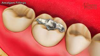 What are Amalgam Fillings When is it used [upl. by Revert]