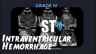 Postpartum Hemorrhage Nursing Interventions [upl. by Sherer]