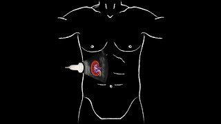 POCUS  Basic Renal Ultrasound [upl. by Clovah]