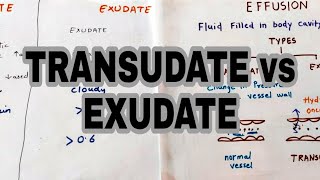 Transudate vs Exudate  Types of effusion  lights criteria [upl. by Aneetsirk367]