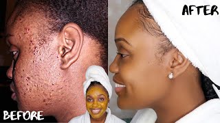 HOW TO GET RID OF ACNE SCARS AND DARK MARKS FAST  DIY TURMERIC HONEY LEMON AND ALOE FACE MASK [upl. by Valry]