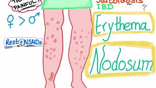 Erythema Nodosum [upl. by Emmit583]