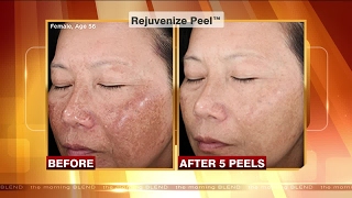 The Benefits of a Chemical Peel [upl. by Cavil693]