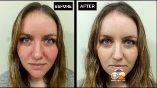 Dr Max Gomez Rosacea Treatment [upl. by Aaronson]