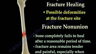 Fracture Healing Part 1  Everything You Need To Know  Dr Nabil Ebraheim [upl. by Asile]