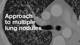 Understanding NonSmall Cell Lung Cancer [upl. by Hedwiga]