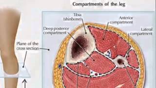 What is Compartment Syndrome  TheNurseNinja [upl. by Ennayelhsa]