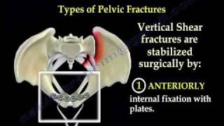 Pelvic Fracture Overview  Everything You Need To Know  Dr Nabil Ebraheim [upl. by Barrett]