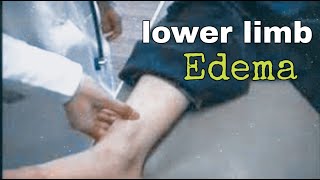 lower limb edema examination [upl. by Conall191]