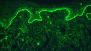 Direct immunofluorescence for autoimmune bullous diseases [upl. by Lobiv]