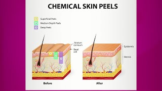 Chemical Peel Purpose amp Types [upl. by Ardnasela376]