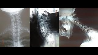 SÍNDROME DE KLIPPEL FEIL  FUSIÓN VERTEBRAL CERVICAL [upl. by Delfeena332]