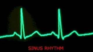 audible heart beat  extrasystoles  PVC and sinus beats [upl. by Tyrus]