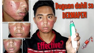 DERMAPEN BEFORE AND AFTER TREATMENT HONEST REVIEW Dermapen VS Dermaroller Dermapen Tutorial At Home [upl. by Mettah]