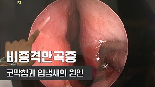 코막힘과 입냄새 두통의 원인 코 연골이 휘었다고 I 비중격만곡증 I 건양대학교 이비인후과 교수 김종엽 I 건강플러스 [upl. by Wichern766]