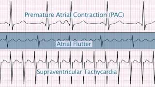 TachycardiaBradycardia Syndrome ECG Findings Explained [upl. by Gilletta]