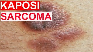 Kaposi Sarcoma [upl. by Ahsenad]