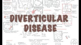 Diverticular Disease diverticulitis  Overview [upl. by Nahn]