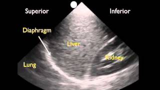 How To Ultrasound Detection of Pleural Fluid Case Study Video [upl. by Aiouqes510]