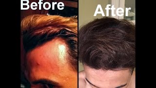 Grow Hair on Receding Hairline Naturally dermaroller and essential oils [upl. by Namzed]