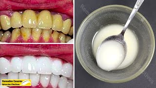 Blanquear Los Dientes En 2 Minutos Con Esta Mezcla Y Obtener Dientes Blancos Naturales [upl. by Llezniuq]