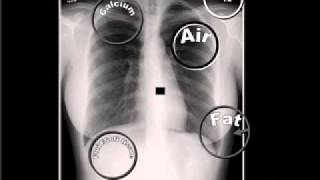 01 The 5 Basic Radiographic Densities [upl. by Halladba550]