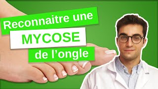 Savoir RECONNAÎTRE une MYCOSE de longle  Onychomycose 13 [upl. by Oreste]