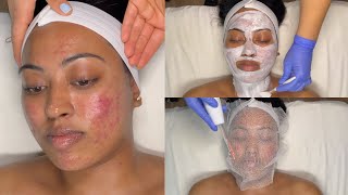 CYSTIC ACNE TREATMENT  WALKIN FACIAL FOR GRADE 3 AND 4 ACNE WITH PRO TIPS  LICENSED ESTHETICIAN [upl. by Berey57]