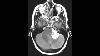 Schwannoma vestibular [upl. by Ravo]