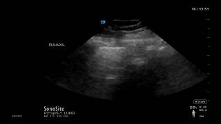 Lung Ultrasound Image Interpretation [upl. by Neona]